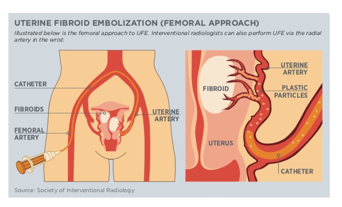 Uterine Fibroid Embolization Femoral Approach